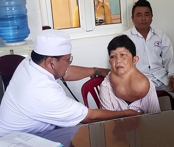 Phẫu thuật thành công cho người phụ nữ 30 năm mang bướu giáp khổng lồ trên cổ