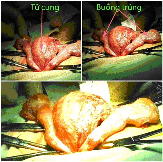 Bệnh hiếm gặp: Một người đàn ông có tử cung và buồng chứng được phẫu thuật tại Bệnh viện quân y 120