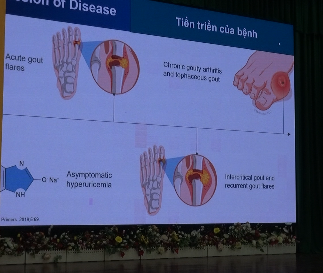 GS.TS.BS Nguyễn Đức Công chia sẻ về bệnh GOUT
